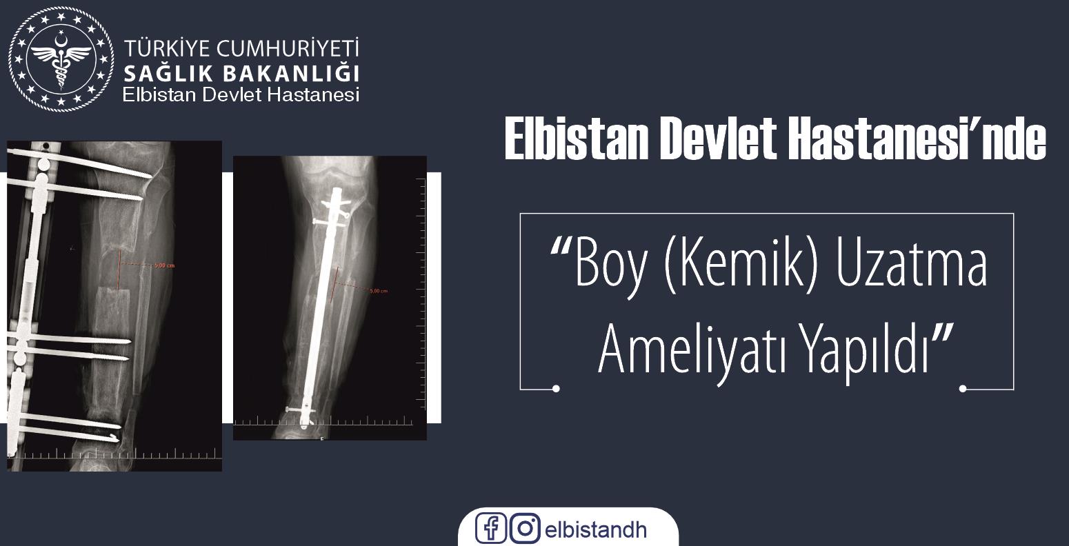 Elbistan Devlet Hastanesi’nde Boy (Kemik) Uzatma Ameliyatı Yapıldı